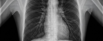 Chest X-Ray preview